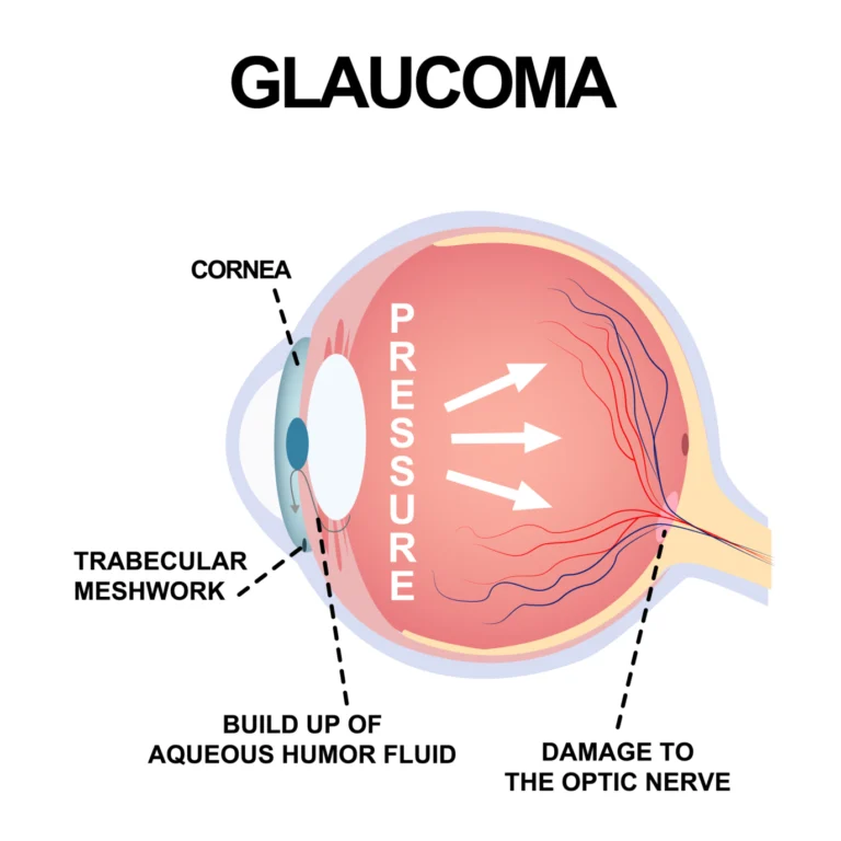 Glaucoma: Out of the Shallows
